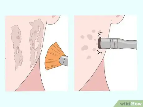 Image titled Get Rid of Acne Scars Fast Step 10