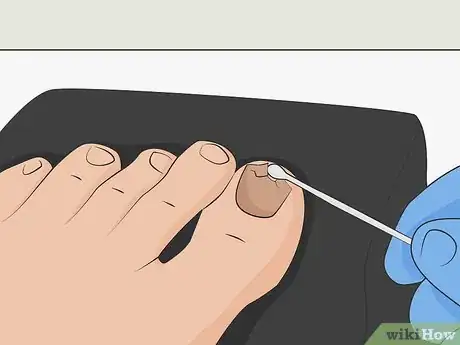 Image titled Heal a Bruised Toenail Quickly Step 14