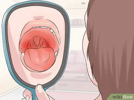 Image titled Reduce Uvula Swelling Step 11