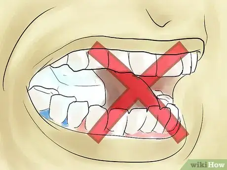 Image titled Eat With Separators in Your Mouth Step 9