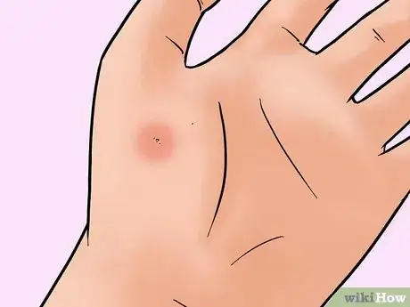Image titled Remove a Pin or Tack from Your Skin Step 9