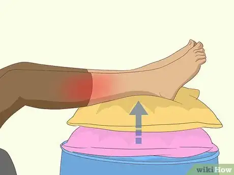 Image titled Get Rid of Leg Pain Step 2