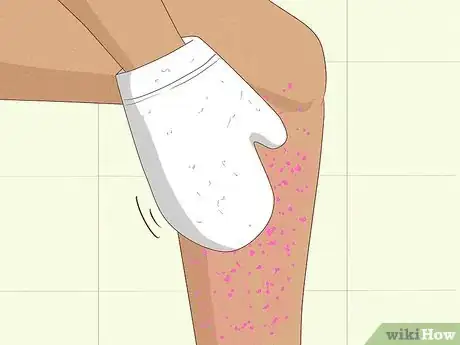 Image titled Remove Deep Ingrown Hairs Step 9