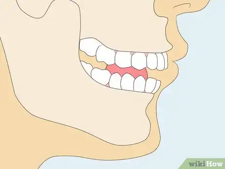 Image titled Stop Grinding Teeth at Night Step 3