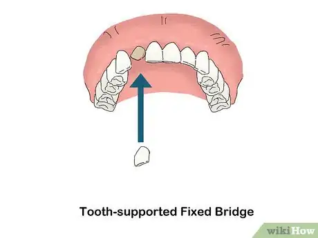 Image titled Buy Dentures Step 4