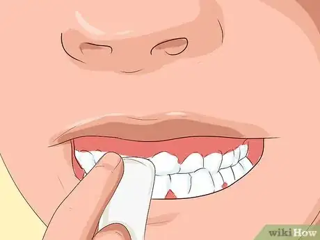 Image titled Pull Out a Tooth Step 7