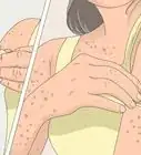 Prevent Chicken Pox Scars