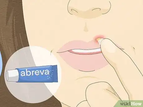 Image titled Get Rid of a Cold Sore Fast Step 1