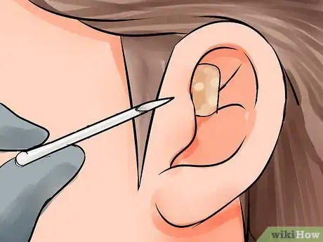 Image titled Pierce Your Forward Helix Step 10