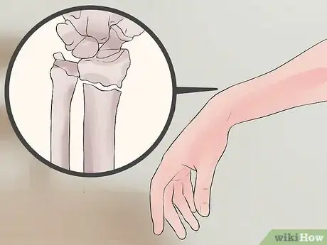 Image titled Tell the Difference Between a Wrist Sprain and a Wrist Fracture Step 6