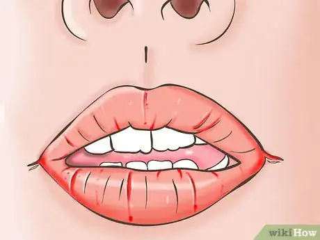 Image titled Know if You Have Oral Thrush Step 2