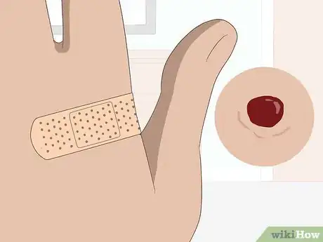 Image titled Heal Mosquito Bites Fast Step 11