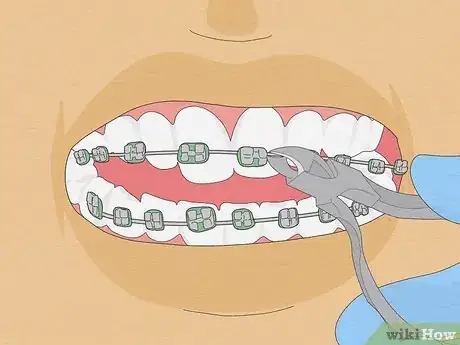 Image titled Fix Crooked Teeth Step 25