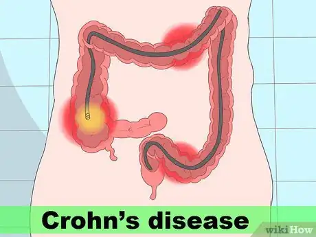 Image titled Diagnose a Fistula Step 12