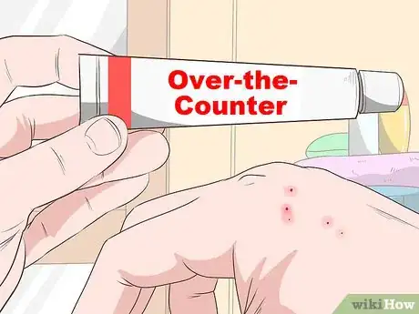 Image titled Stop Mosquito Bites from Itching Step 7