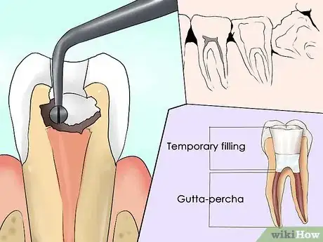 Image titled Endure a Root Canal Step 2