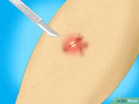 Image titled Treat a Staph Infection Step 5
