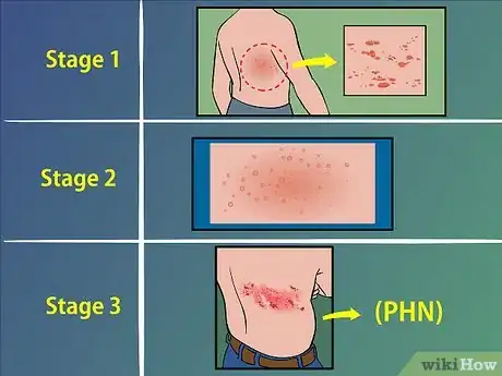 Image titled Treat Shingles (Herpes Zoster) Step 2