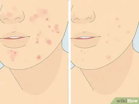 Image titled Reduce Acne Using Tomatoes Step 2