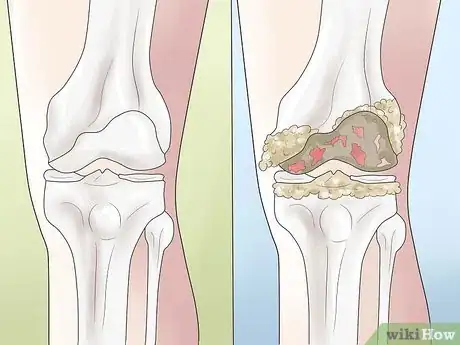 Image titled Know if You Have a Baker's Cyst Step 10