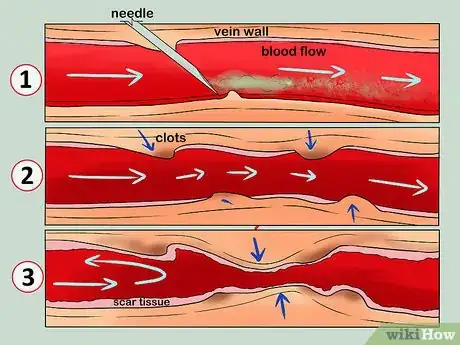 Image titled Know when Your Vein Has Collapsed Step 4