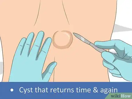 Image titled Remove a Cyst on Your Back Step 8