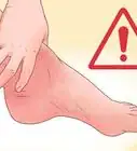 Cure a Swollen Ankle