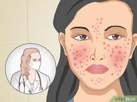 Image titled Prevent Acne Naturally Step 18