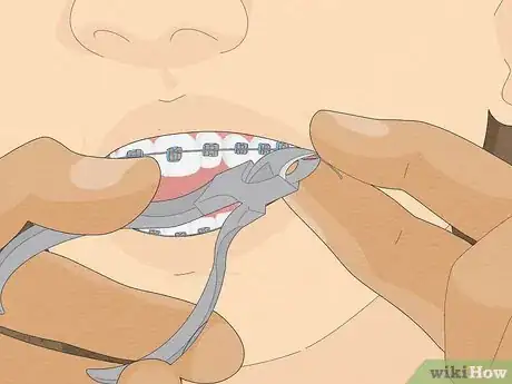 Image titled Temporarily Fix a Loose Wire on Your Braces Step 11