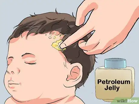 Image titled Prevent Cradle Cap Step 6