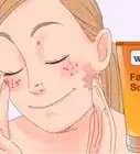 Remove the Redness of a Pimple