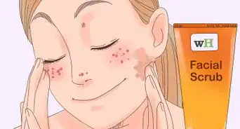 Remove the Redness of a Pimple