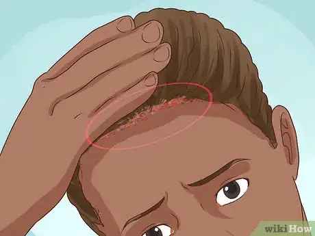 Image titled Diagnose Scalp Psoriasis Step 13