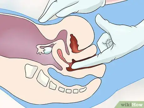 Image titled Diagnose Uterine Fibroids Step 5