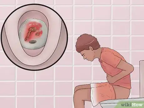 Image titled Distinguish Ulcerative Colitis from Similar Conditions Step 1
