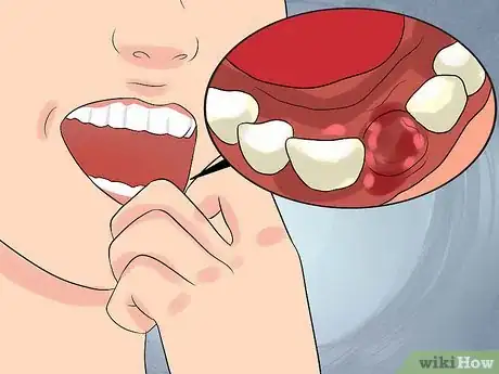 Image titled Deal With a Tooth Pulling Step 11
