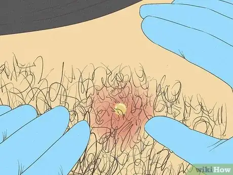 Image titled Prevent Ingrown Hairs on the Pubic Area Step 13