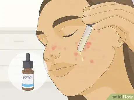 Image titled Get Rid of a Pimple Step 1