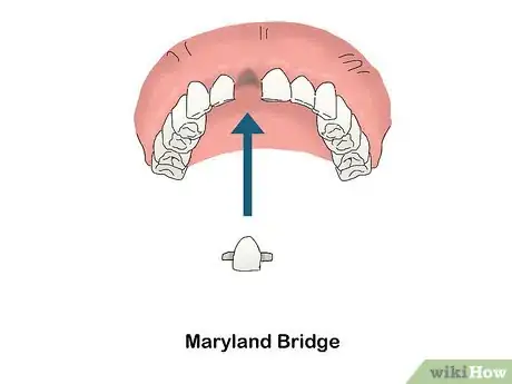Image titled Buy Dentures Step 6