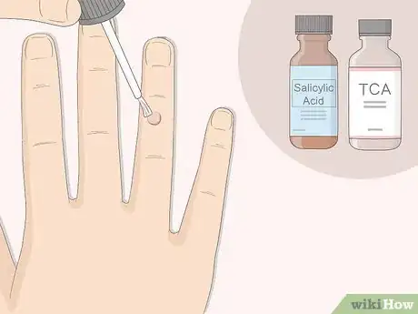 Image titled Get Rid of Warts Step 2