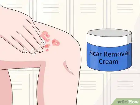 Image titled Prevent Burn Scars Step 10