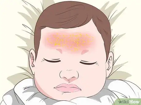 Image titled Identify and Treat Different Types of Diaper Rash Step 8