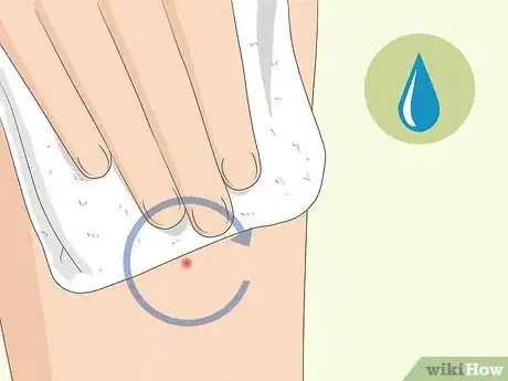 Image titled Remove Deep Ingrown Hairs Step 1