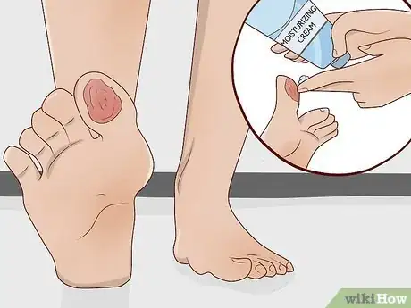 Image titled Remove Calluses Naturally Step 2