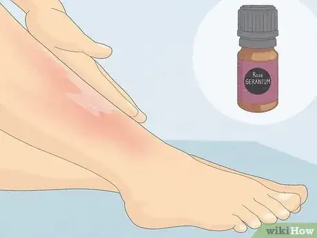 Image titled Reduce Redness After Waxing Step 16