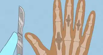 Get Rid of Arthritis Bumps on Fingers