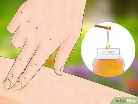 Image titled Get Bug Bites to Stop Itching Step 5