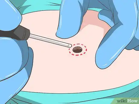 Image titled Remove Moles Without Surgery Step 7