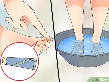 Image titled Know if You Have Nail Fungus Step 11