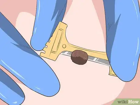 Image titled Remove Moles Without Surgery Step 3